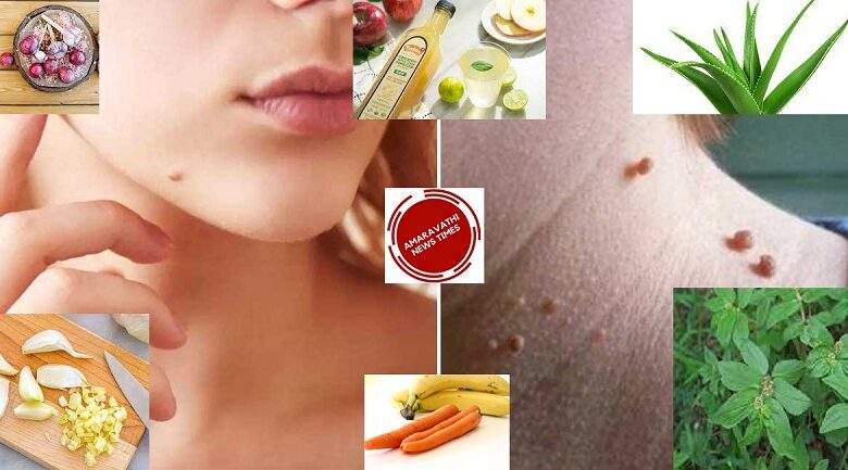 Natural Tips To Reduce Pimples & Warts