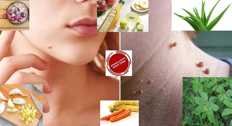 Tips To Reduce Pimples & Warts Naturally